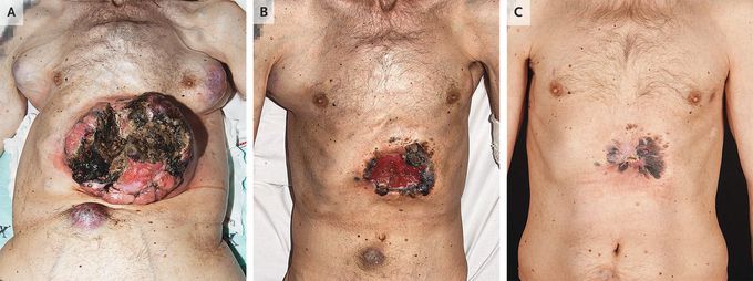 Targeted Therapy in Melanoma