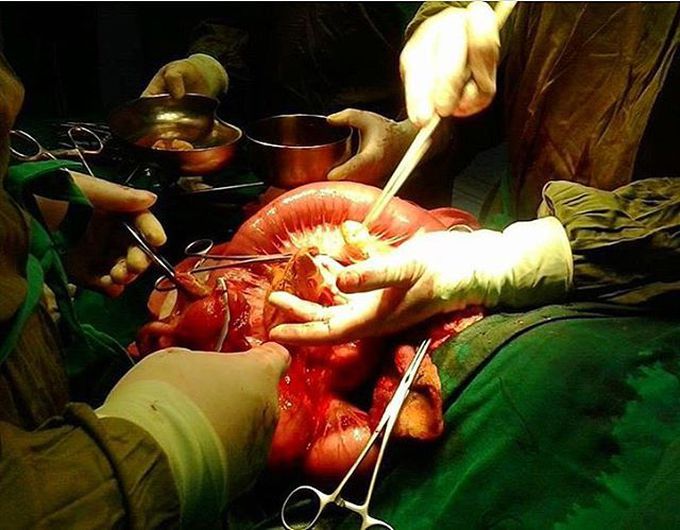 Colon cancer surgery