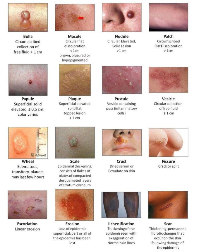 Skin Lesions