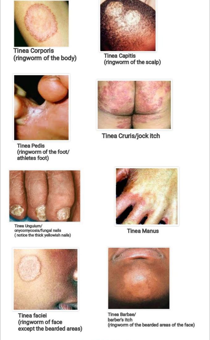 Tinea infections
