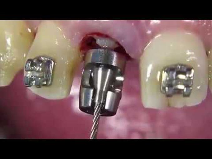 Benex Extraction System