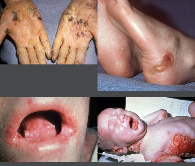 Epidermolysis Bullosa