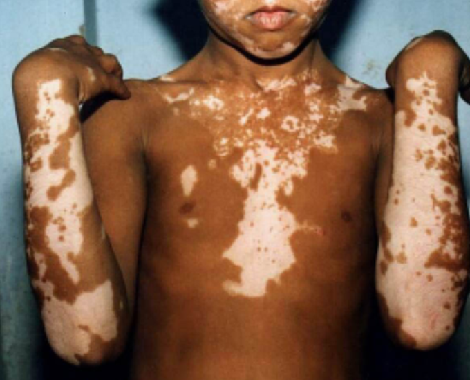 Skin disease