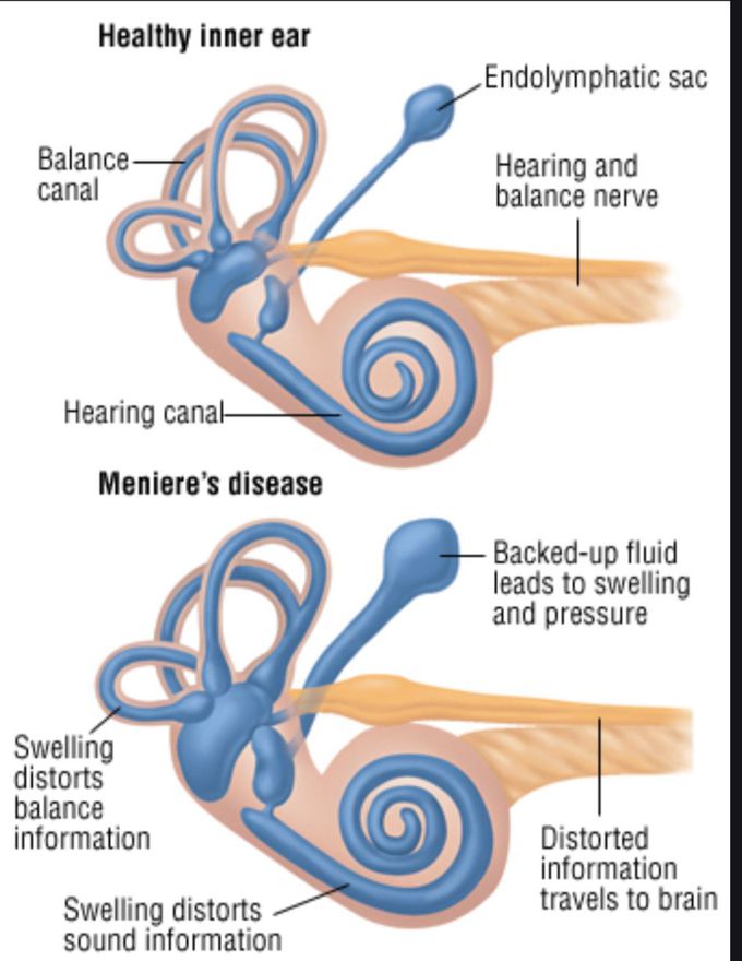 Meniere’s disease