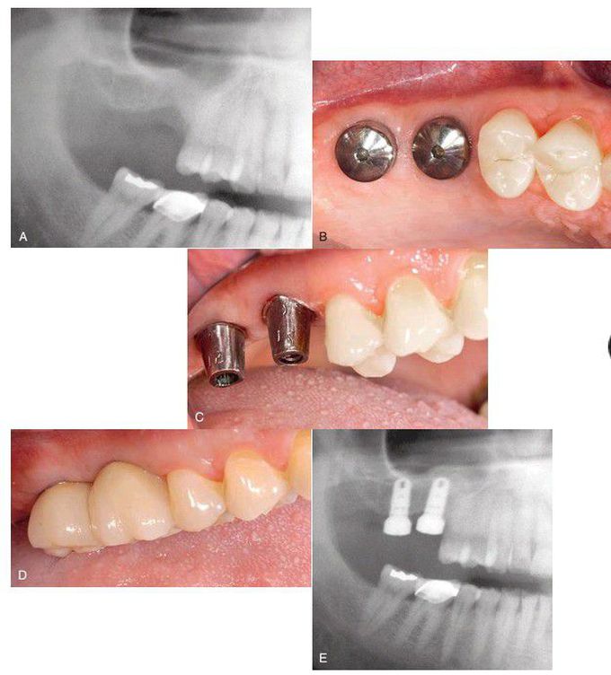 Replacement of two adjacent posterior maxillary teeth.