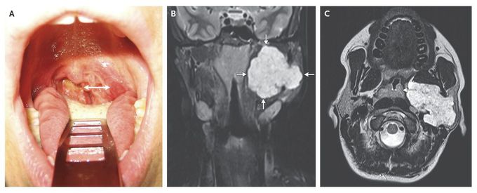Tonsillar Asymmetry from a Parotid Tumor