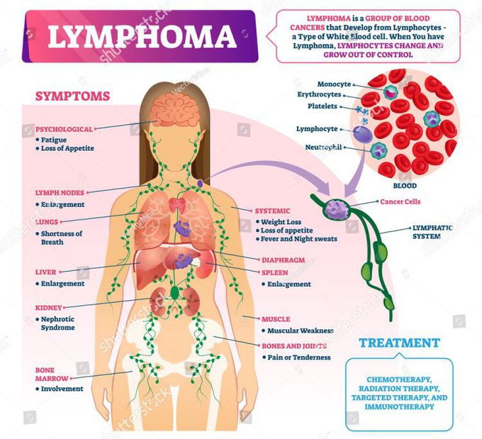 Hodgkin’s lymphoma