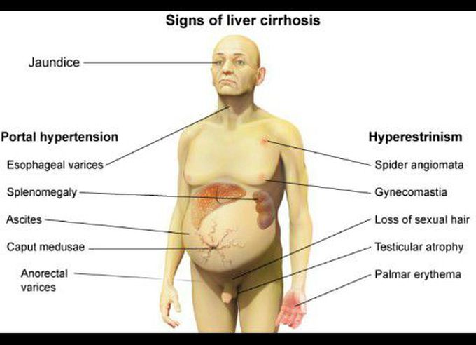 Liver cirrhosis