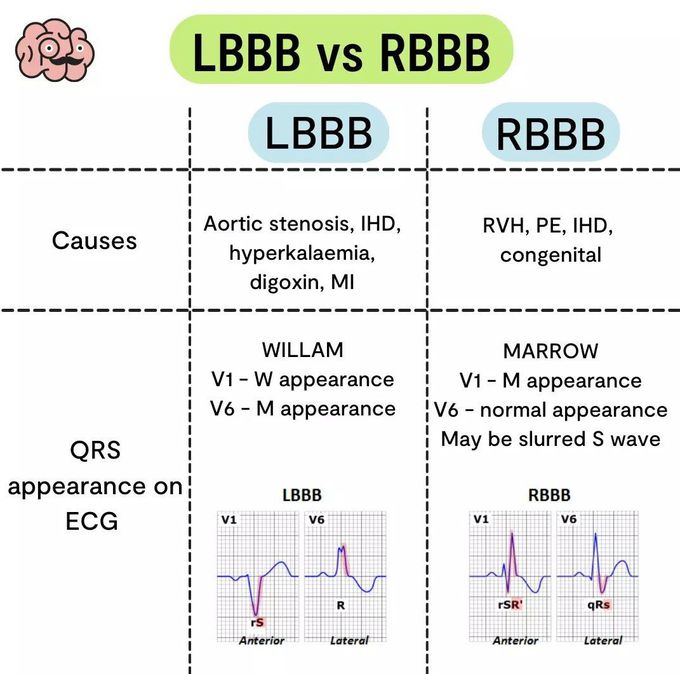 LBBB Vs RBBB