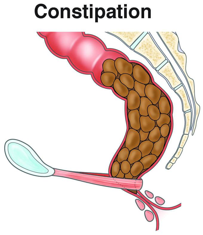 What medical treatments can help with constipation?