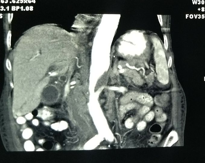 Ct of a 71 yr old woman with ca stomach.... Can anyone tell about a significant finding seen in this film