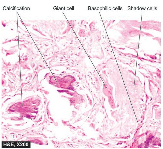 Pilomatricoma (calcifying epithelioma of Malherbe).