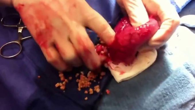 Unbelievable huge stones removed from patient's Bladder!