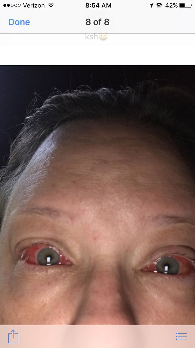 Viral conjunctivitis