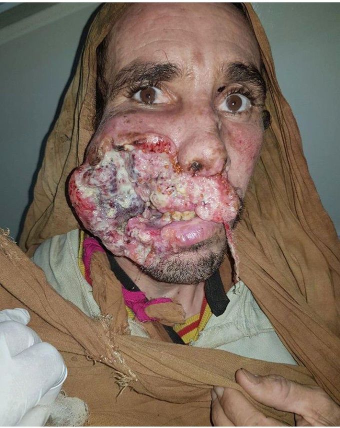 Epidermoid Carcinoma...