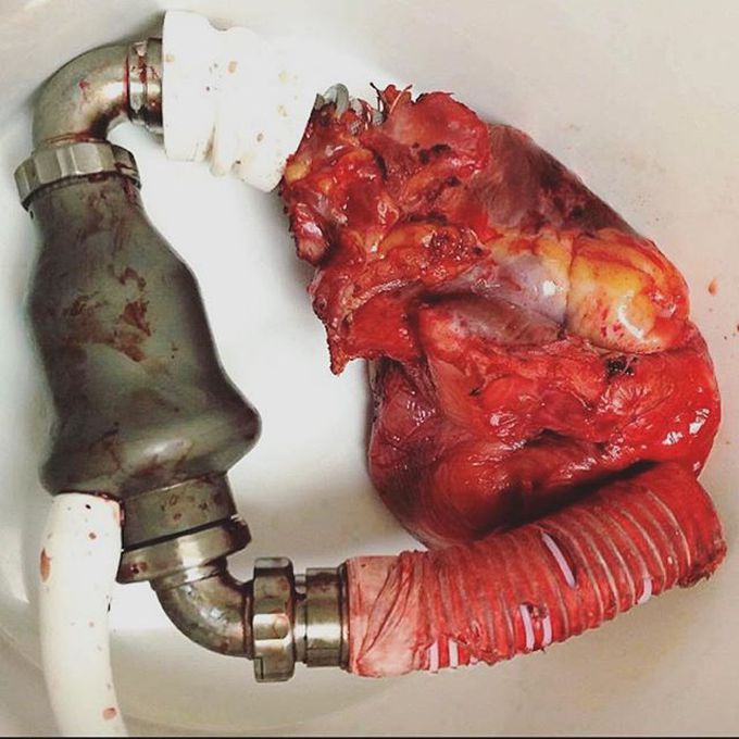 This is how they deal with the heart till it is transplanted