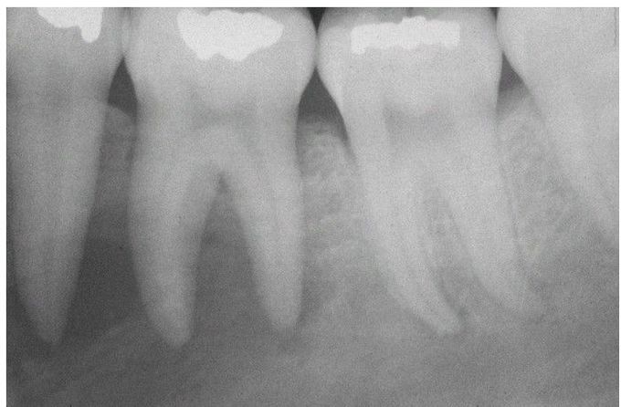 Massive Osteolysis.