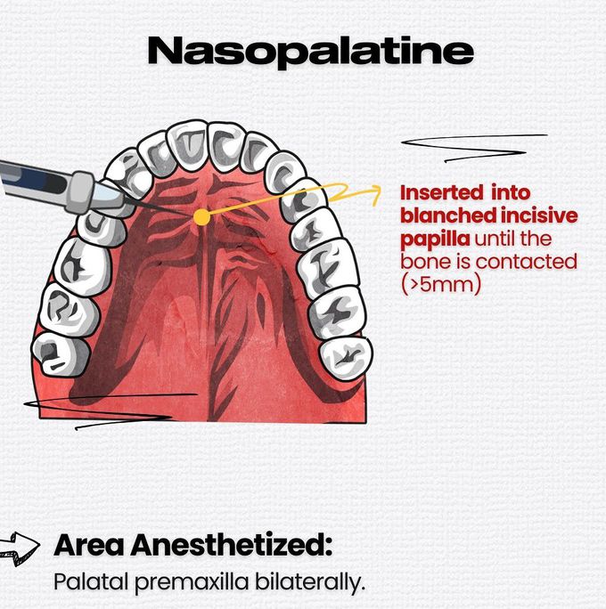 Maxillary Local Anesthesia III