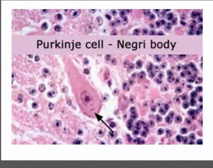 Negri Body in case of Rabies
