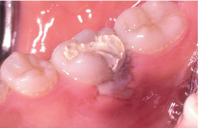 Formocresol Burn.