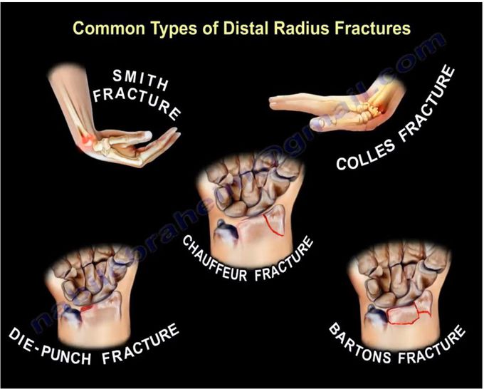 Distal Radius Fracture