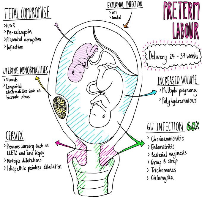 Preterm Labour - Causes