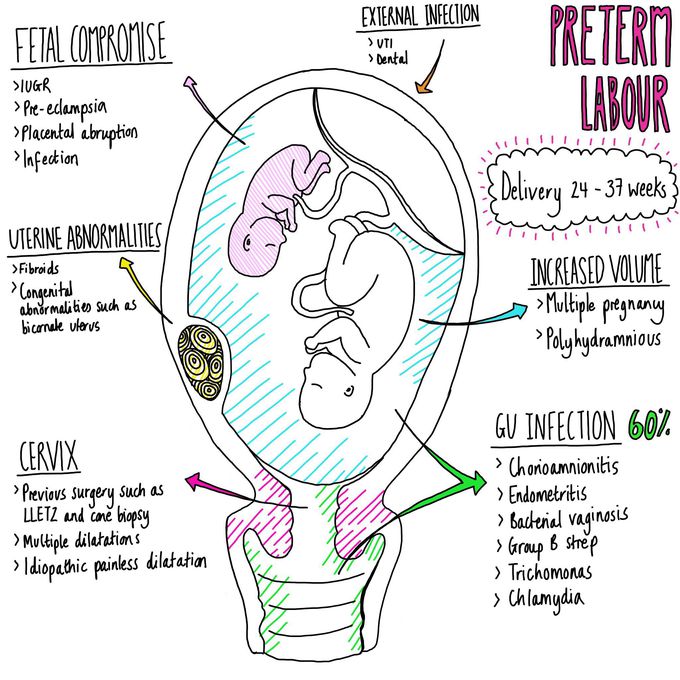 preterm-labour-causes-medizzy