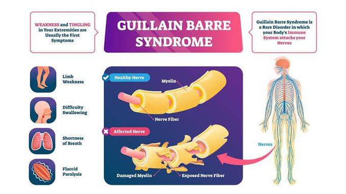 Guillaine-barre syndrome