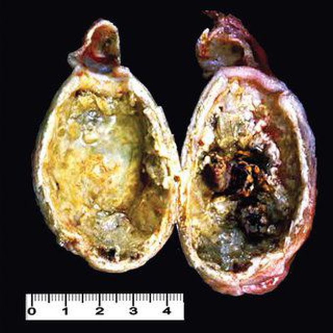 Porcelain Gallbladder AKA Cholecystopathia Chronica Calcarea