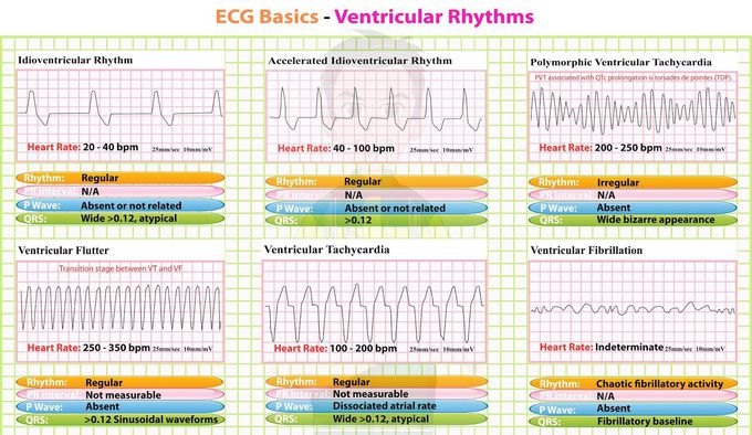 Basic ecg rhythms.