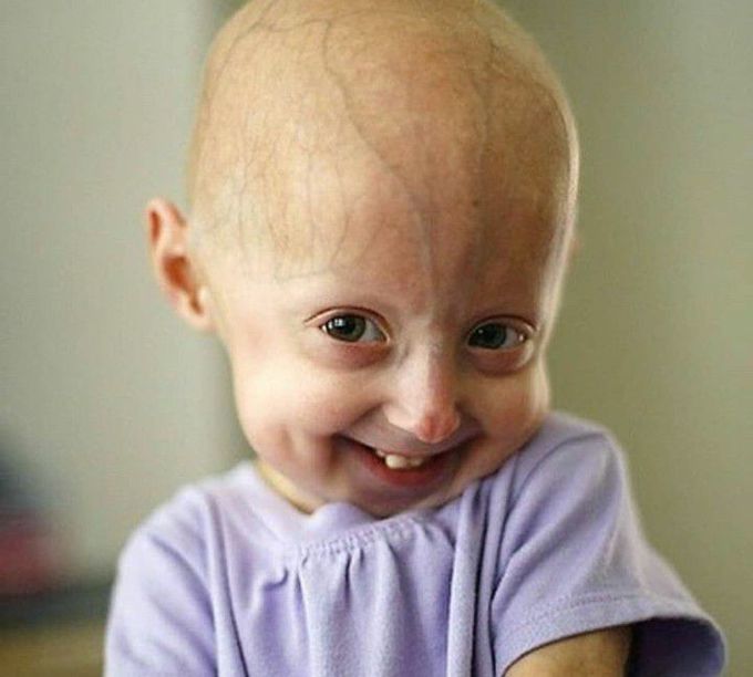 PROGERIA