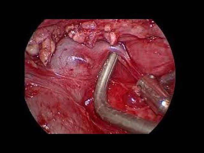 Subxiphoid VATS Thymectomy After Cardiac Surgery