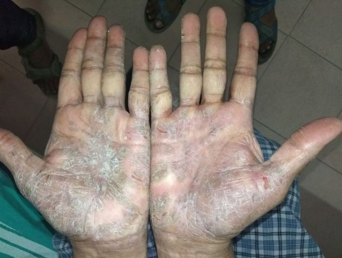 Palmar psoriasis