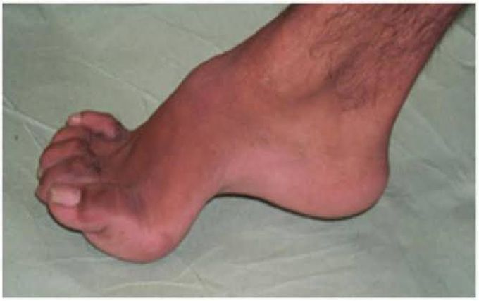 The Friedreich’s Foot