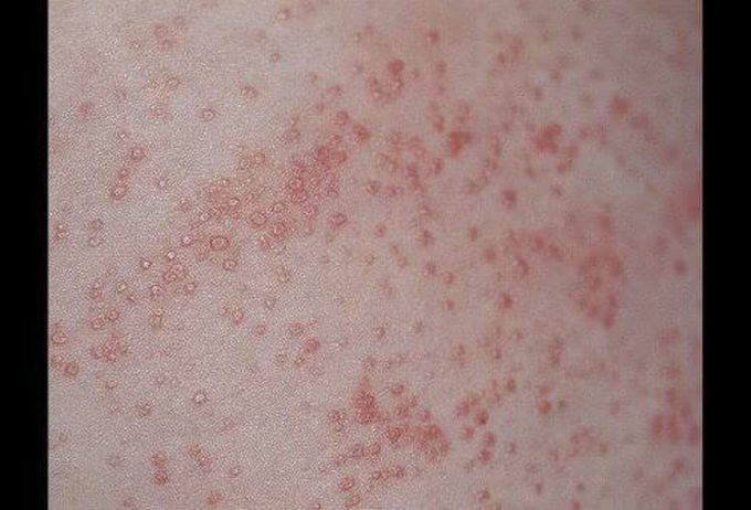 Miliaria rubra or prickly heat or sweat rash