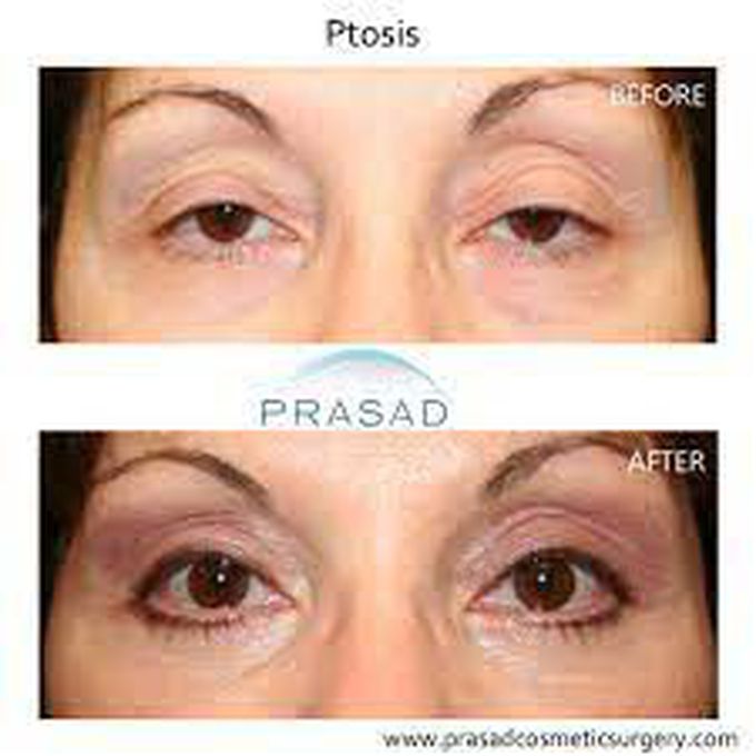 What causes ptosis?