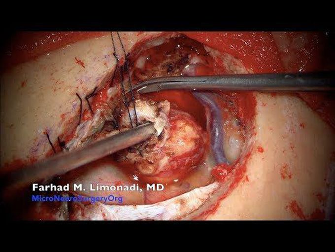 Surgical resection of brain tumor (meningioma).  Complete video presentation.