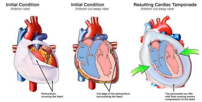 Cardiac Tamponade