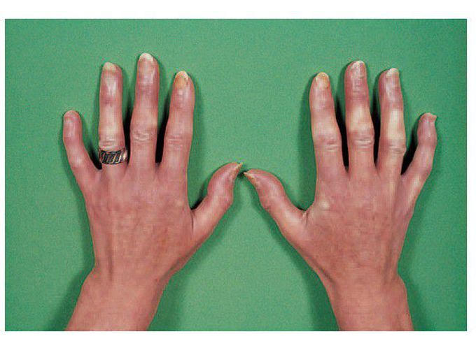 Raynaud's phenomenon