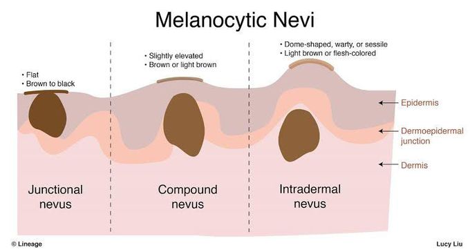 Types of melanocytic nevi