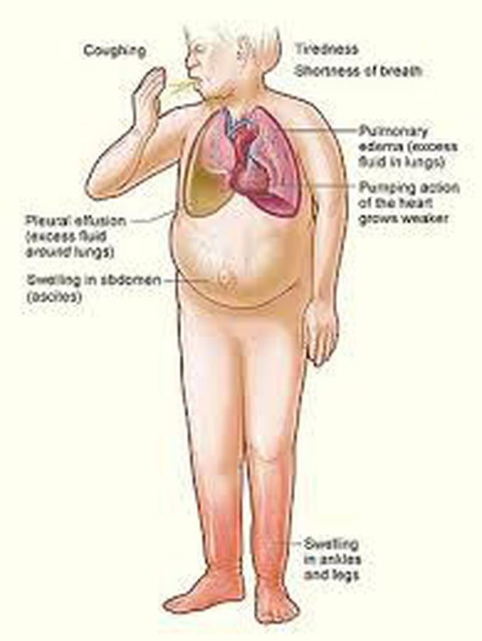 causes-of-congestive-heart-failure-medizzy