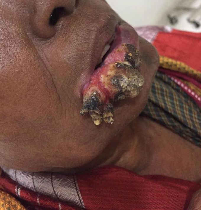 Squamous cell carcinoma 