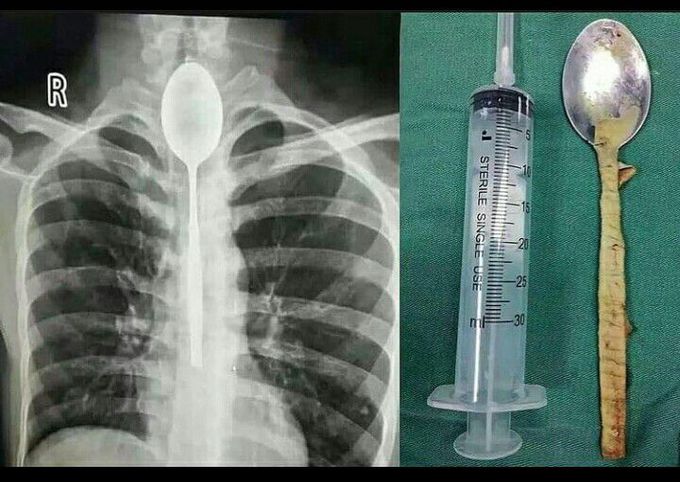 Spoon stuck in esophagus for a year!