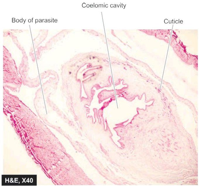 Cysticercus in skeletal muscle