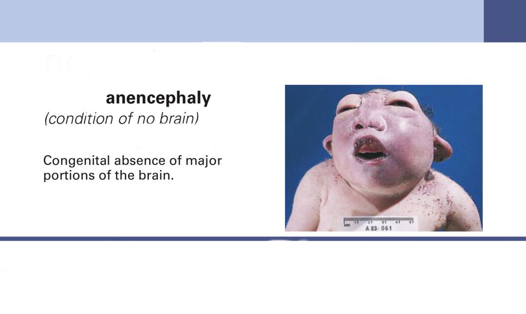 Anencephaly Medizzy