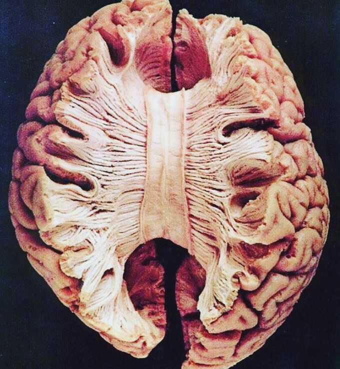 The corpus callosum