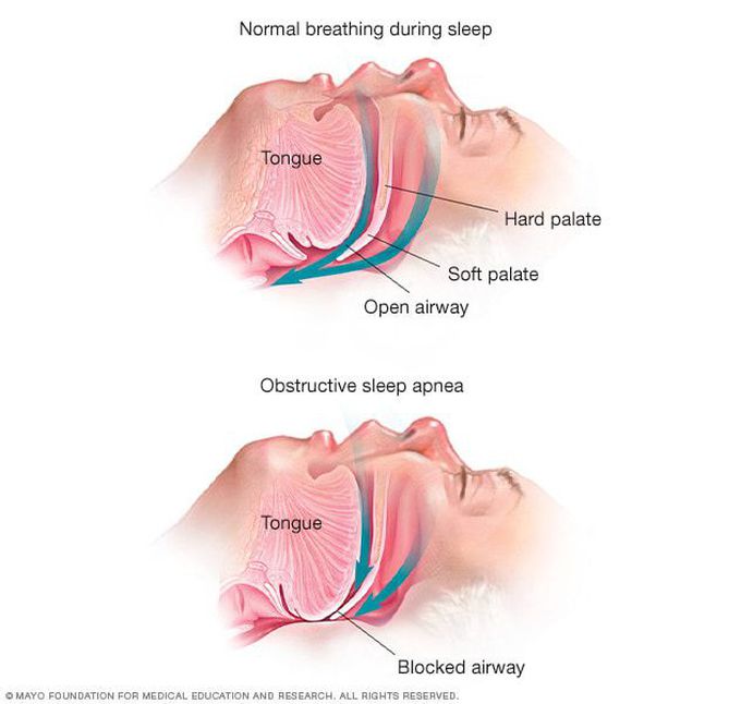 Severe obstructive sleep apnea