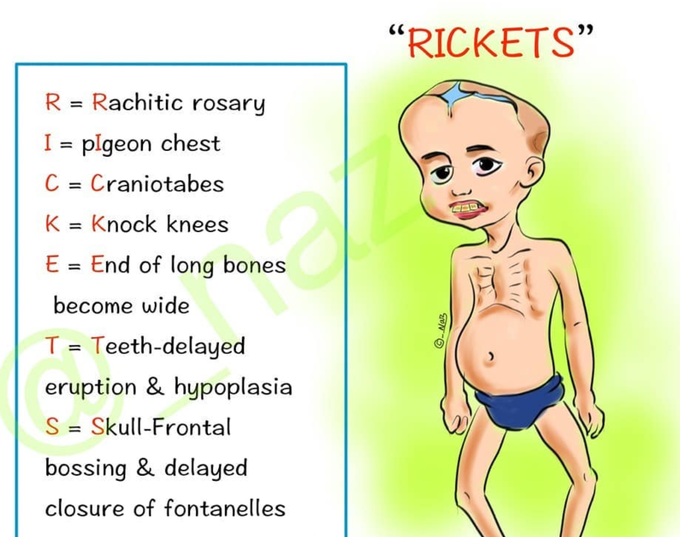 rickets in babies