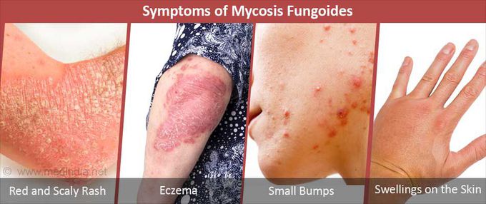 Symptoms of Mycosis