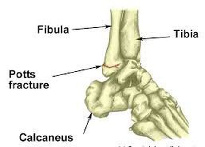 Potts fracture
